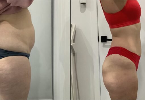 Non Invasive Butt Sculpting Treatments