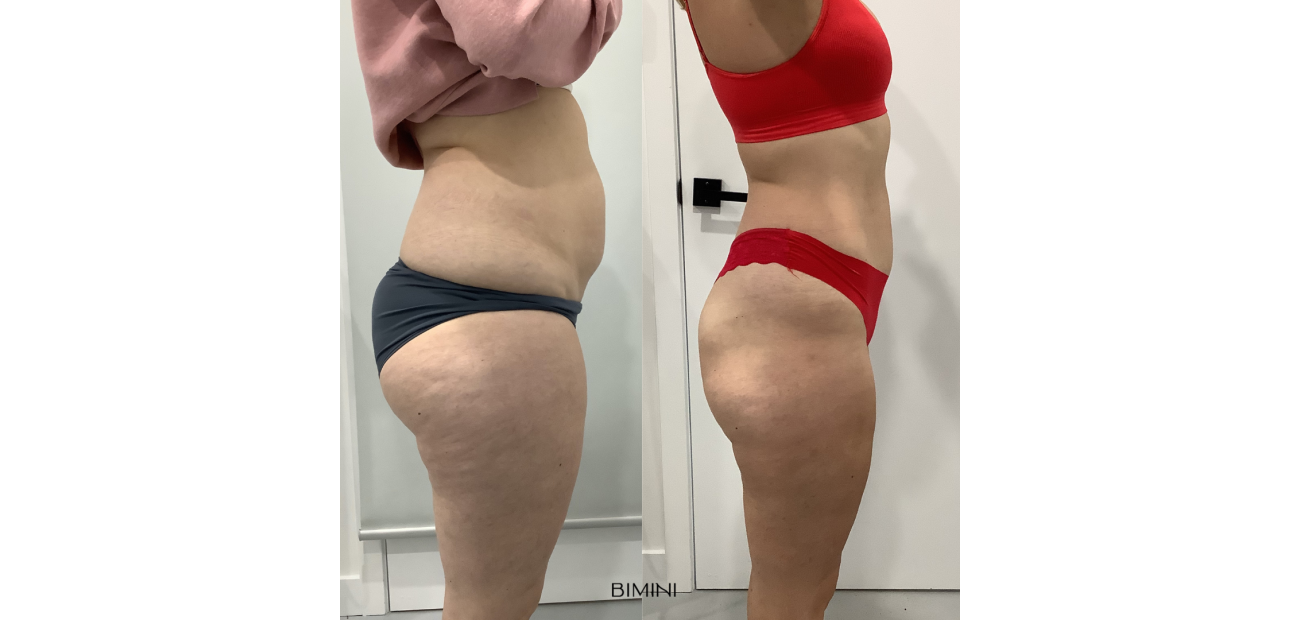 Hifu Liposel Results