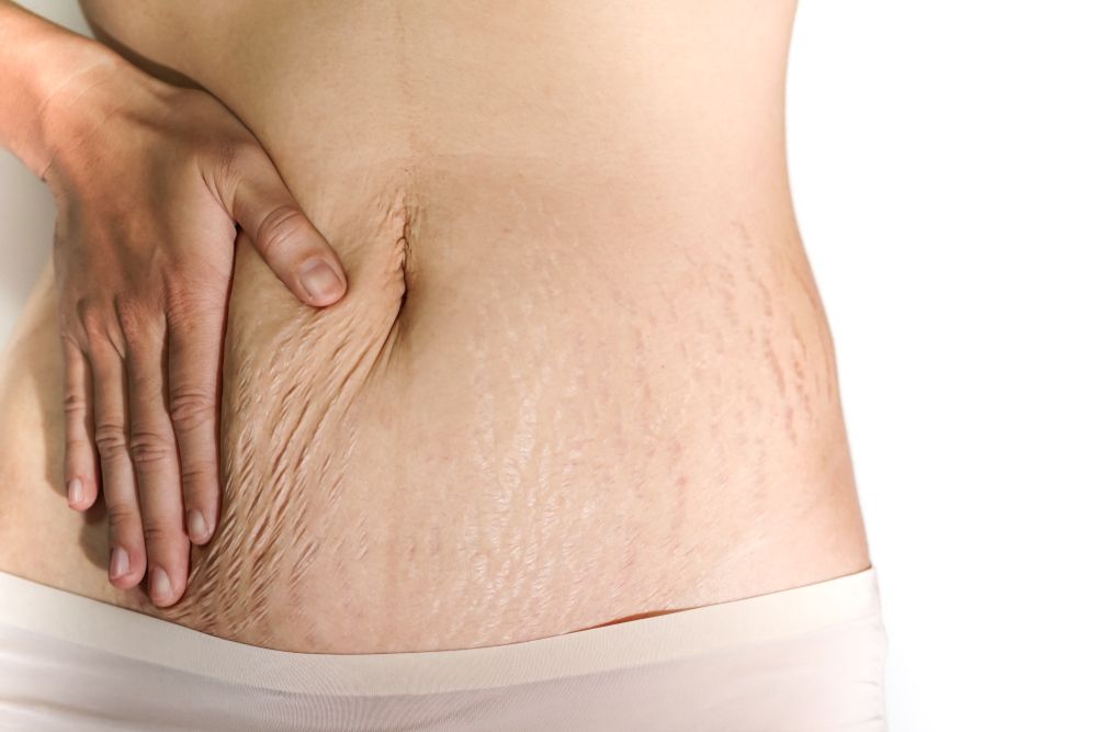 Post Pregnancy Fat Removal
